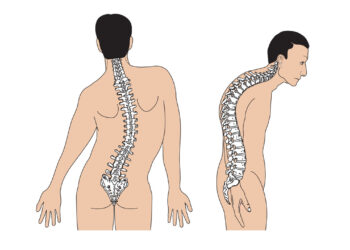 Các dạng cong vẹo cột sống: Những điều bạn cần đặc biệt lưu ý