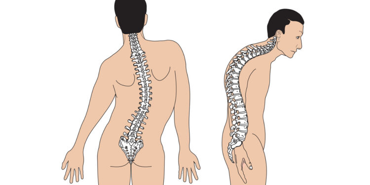 Các dạng cong vẹo cột sống: Những điều bạn cần đặc biệt lưu ý