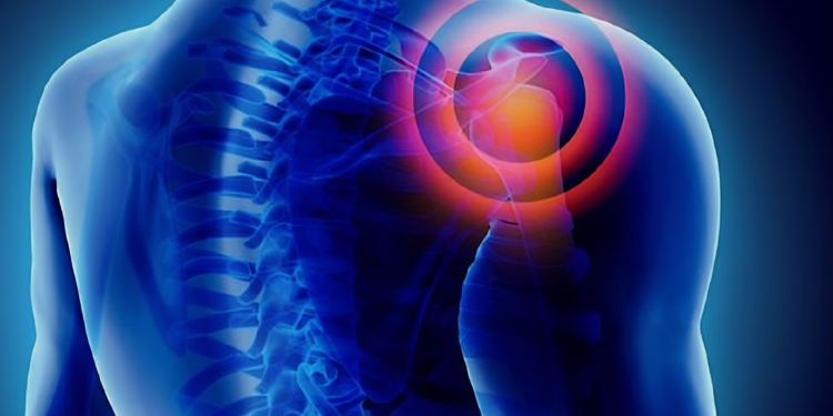 Trật khớp vai là gì? Nguyên nhân, triệu chứng và các phương pháp điều trị