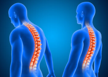 Viêm cột sống dính khớp: Ảnh hưởng của chế độ ăn và cách chăm sóc