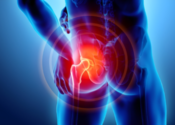 Viêm khớp háng là gì? Nguyên nhân và cách điều trị bệnh