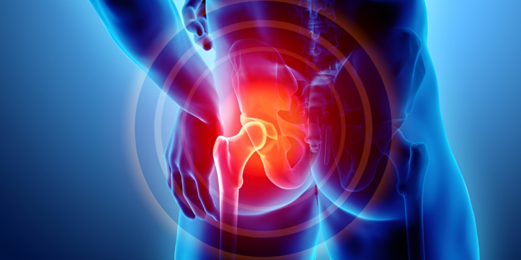 Viêm khớp háng là gì? Nguyên nhân và cách điều trị bệnh