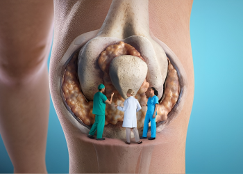 U xương là gì? Nguyên nhân, dấu hiệu và cách điều trị