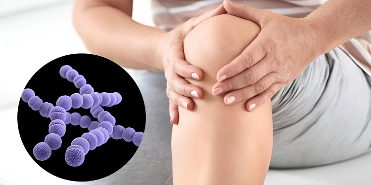 Viêm khớp liên cầu: Nguyên nhân, dấu hiệu và cách điều trị