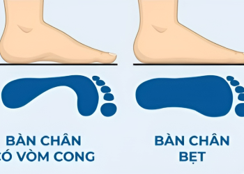 Bàn chân bẹt là gì? Nguyên nhân, triệu chứng và phương pháp phòng ngừa