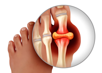 Bệnh gout là gì? Nguyên nhân, triệu chứng và cách điều trị