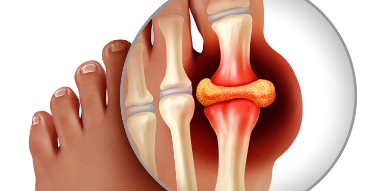 Bệnh gout là gì? Nguyên nhân, triệu chứng và cách điều trị