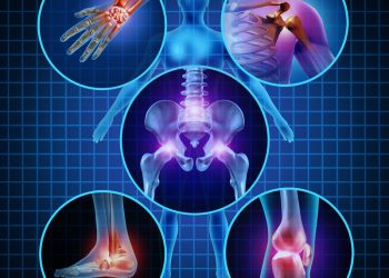 Bệnh viêm đa khớp là gì? Nguyên nhân, triệu chứng và cách điều trị bệnh