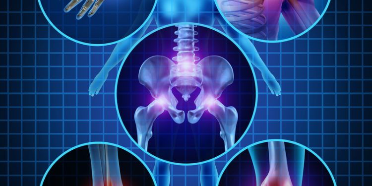 Bệnh viêm đa khớp là gì? Nguyên nhân, triệu chứng và cách điều trị bệnh