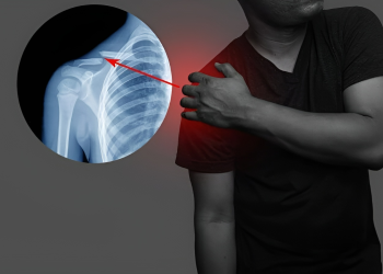 Gãy xương đòn là gì? Nguyên nhân, dấu hiệu và cách phòng ngừa
