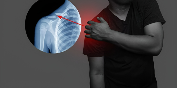 Gãy xương đòn là gì? Nguyên nhân, dấu hiệu và cách phòng ngừa