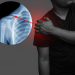 Gãy xương đòn là gì? Nguyên nhân, dấu hiệu và cách phòng ngừa