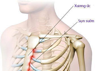 Gãy xương ức là gì? Nguyên nhân, triệu chứng và phương pháp điều trị