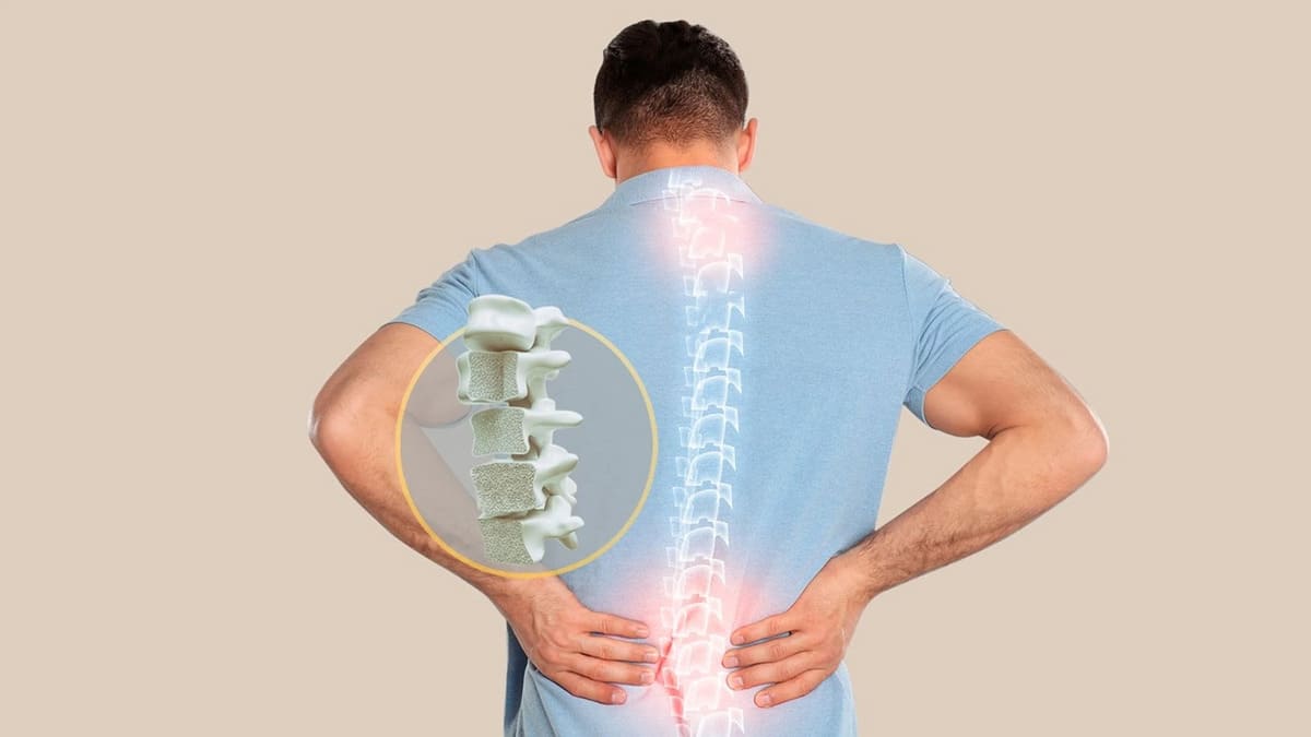 Giảm mật độ xương gây ra tình trạng xương ở cột sống bị xẹp