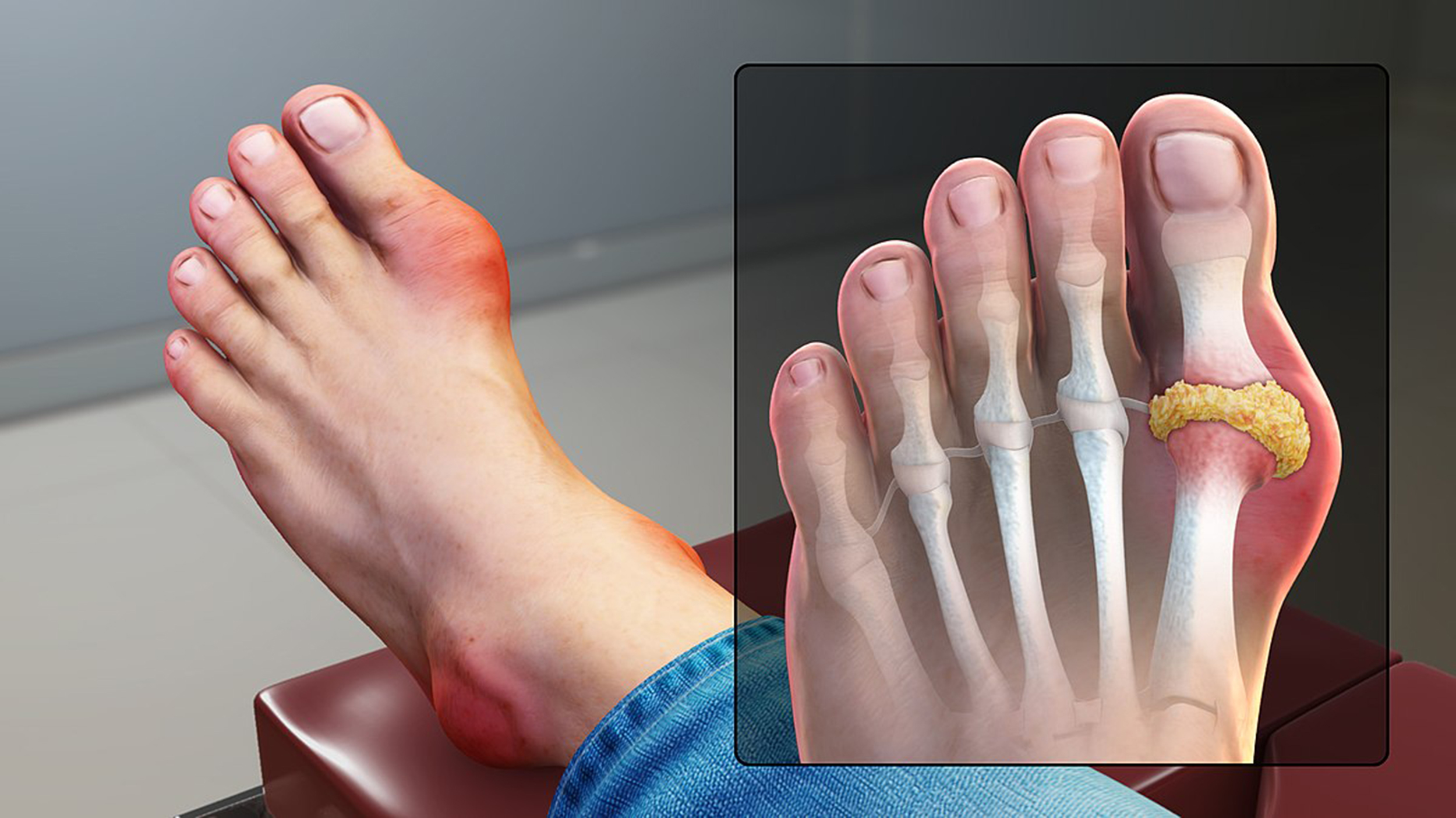 Bệnh gout là gì là câu hỏi nhiều người thắc mắc