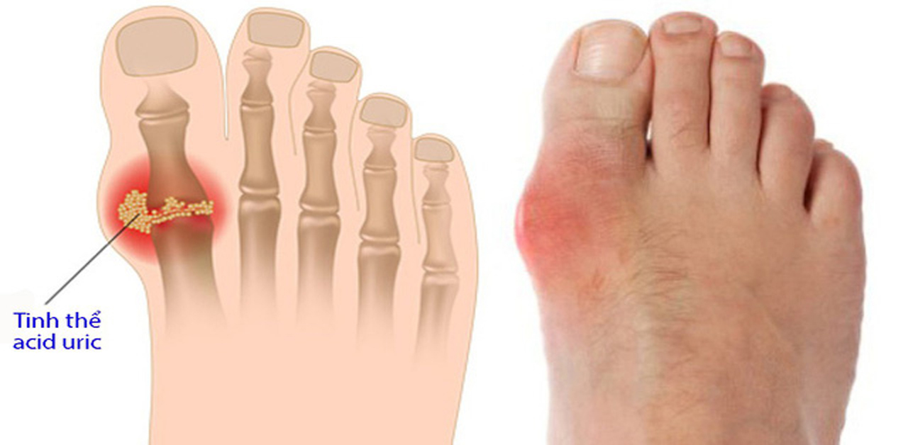Bệnh gout phát triển nặng dần theo thời gian