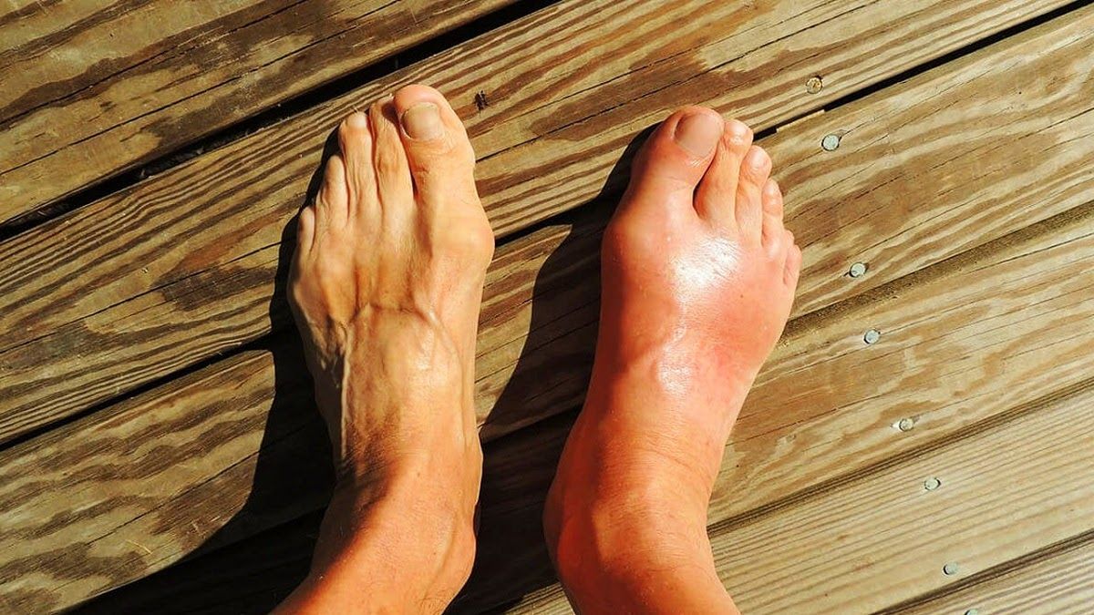 Bệnh gout thuộc dạng bệnh viêm khớp vi tinh thể