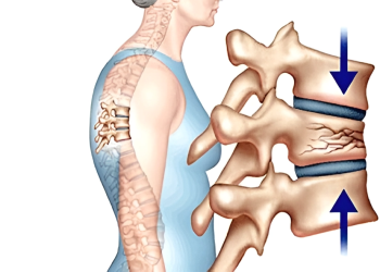 Bệnh loãng xương ở người già: Nguyên nhân và cách điều trị