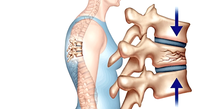 Bệnh loãng xương ở người già: Nguyên nhân và cách điều trị