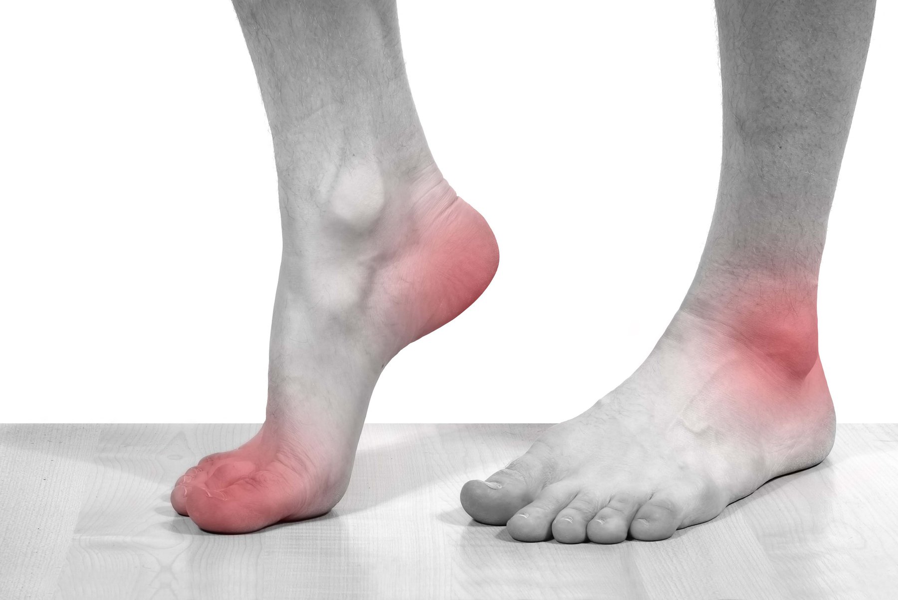 Người bệnh bị gout vô căn sẽ có quá trình tổng hợp purin nội sinh cao