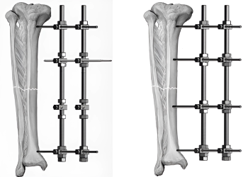 Phẫu thuật kết hợp xương: Chỉ định và quy trình thực hiện