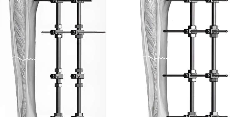 Phẫu thuật kết hợp xương: Chỉ định và quy trình thực hiện