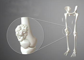 Sarcoma xương là gì? Nguyên nhân, dấu hiệu và cách điều trị