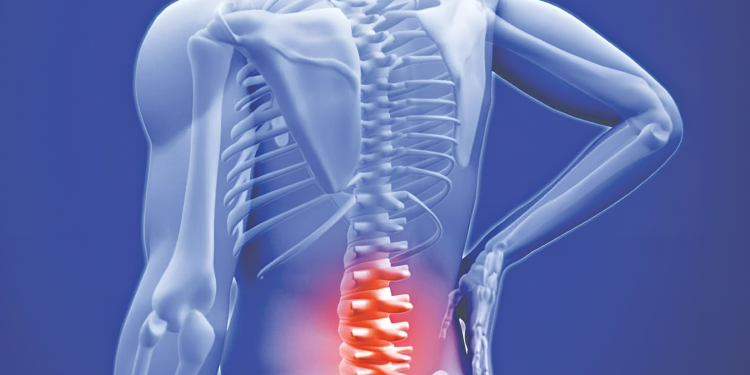 Thoái hóa cột sống thắt lưng là gì? Nguyên nhân và điều trị