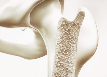 Loãng xương nên uống sữa gì? Top 10 sữa tốt cho người bệnh