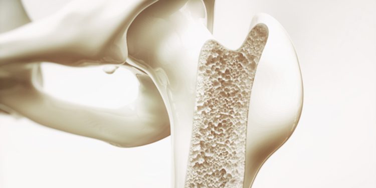 Loãng xương nên uống sữa gì? Top 10 sữa tốt cho người bệnh