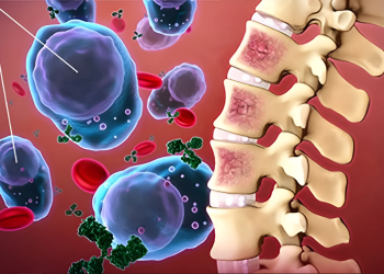 Ung thư xương là gì? Nguyên nhân, dấu hiệu và cách điều trị