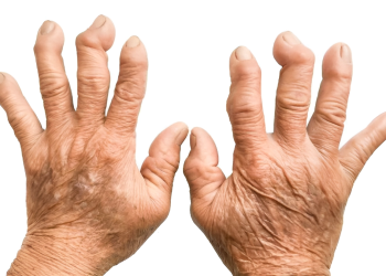 Viêm đa khớp dạng thấp: Nguyên nhân, triệu chứng và điều trị