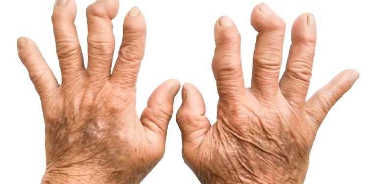 Viêm đa khớp dạng thấp: Nguyên nhân, triệu chứng và điều trị