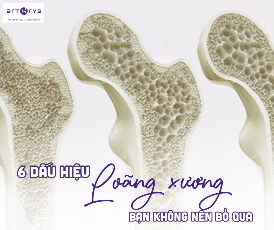 6 dấu hiệu loãng xương bạn không nên bỏ qua