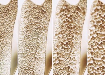 6 dấu hiệu loãng xương bạn không nên bỏ qua