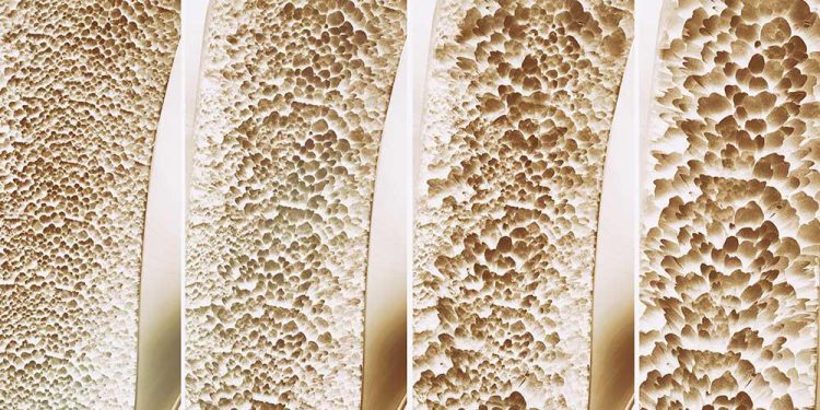 6 dấu hiệu loãng xương bạn không nên bỏ qua