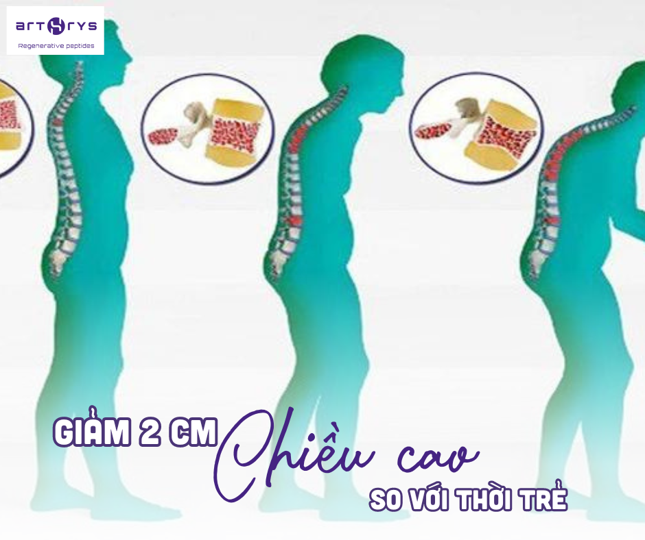 Dấu hiệu loãng xương là bị giảm mất 2cm so với thời trẻ