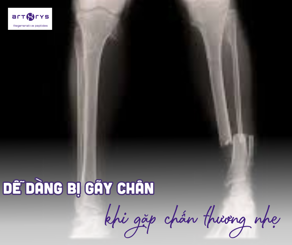 Dấu hiệu loãng xương là chân dễ bị gãy khi gặp chấn thương nhẹ 
