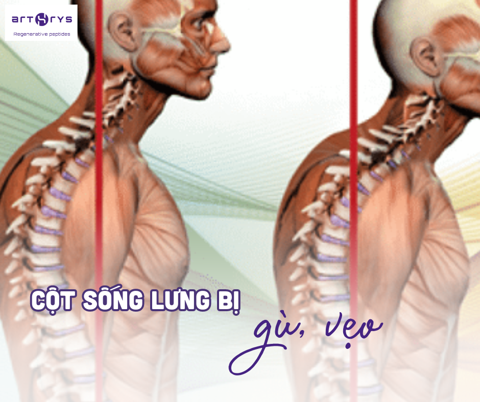 Dấu hiệu loãng xương là  cột sống bị gù vẹo