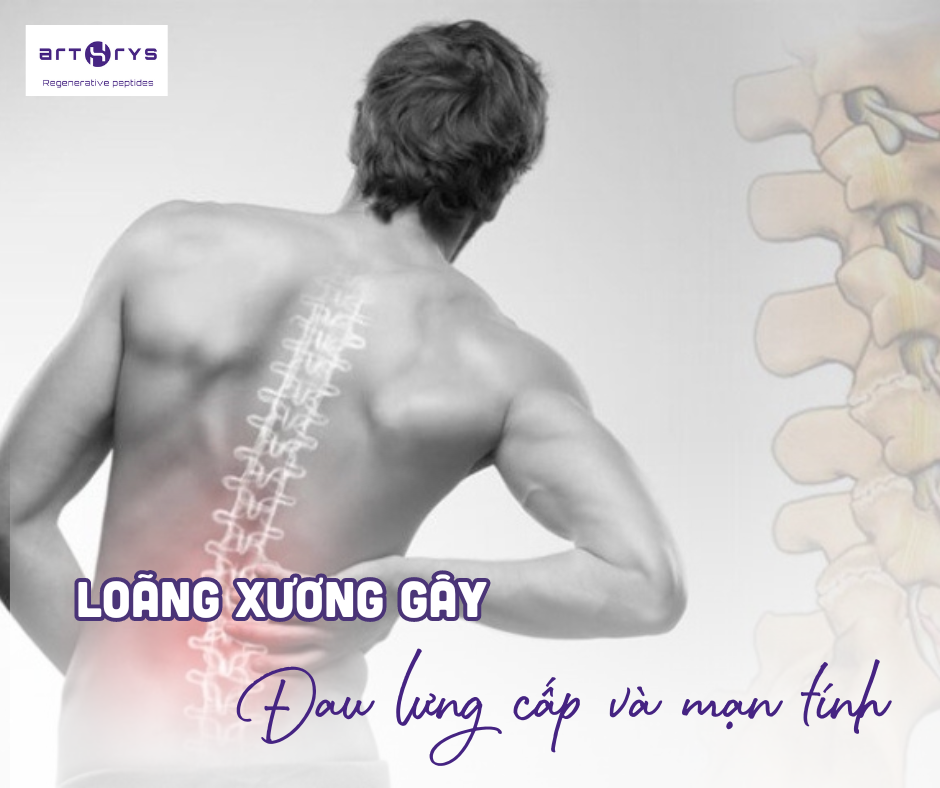 Đau lưng cấp và mãn tính là dấu hiệu loãng xương