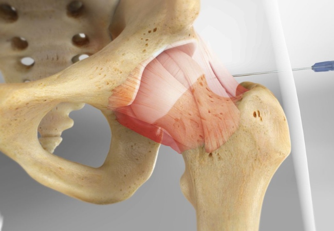 Tại sao phải tiêm chất nhờn sau phẫu thuật khớp là câu hỏi được nhiều người quan tâm
