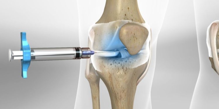 Tại sao phải tiêm dưỡng chất sau phẫu thuật khớp được nhiều người quan tâm