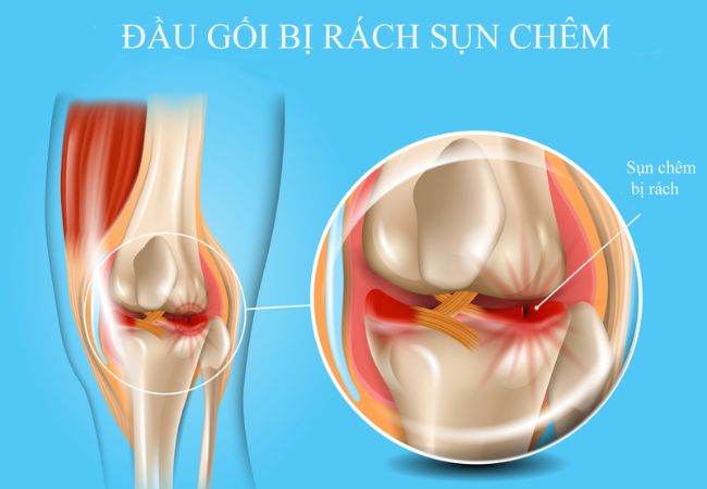 Chấn thương sụn chêm ảnh hưởng tới khả năng đi lại của người bệnh
