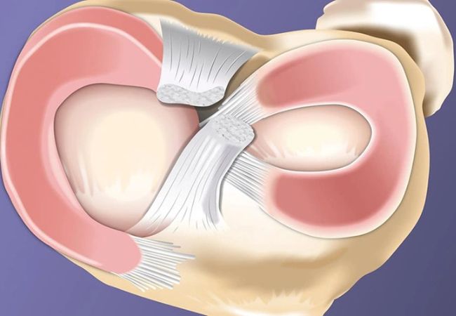 Sụn chêm phân bổ áp lực tác động đều cho khớp gối của cơ thể