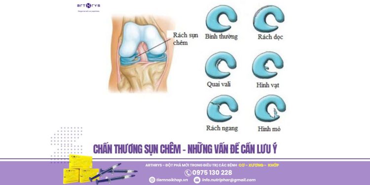 Chấn thương sụn chêm – Những vấn đề cần lưu ý