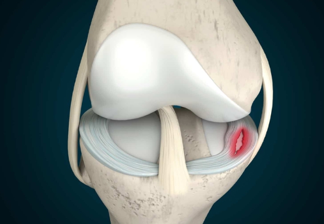 Sụn chêm khó có thể tự phục hồi khi bị chấn thương