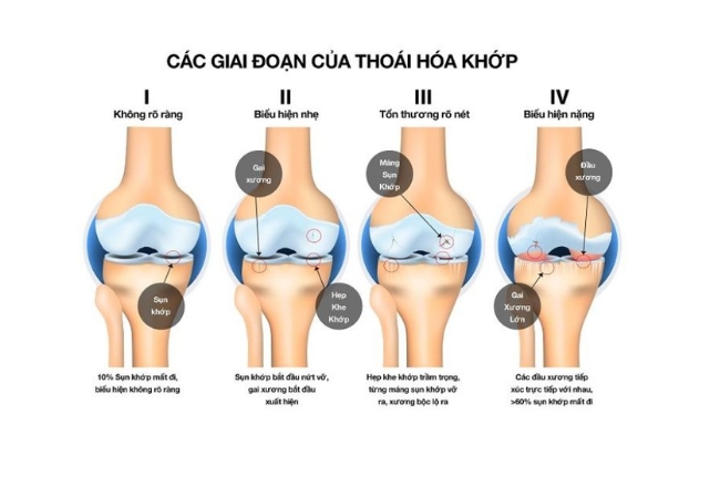 Thoái hóa khớp gối nếu thăm khám sớm có thể mang lại hiệu quả điều trị lên tới 80%