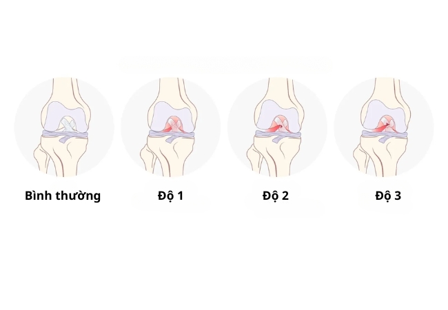 3 mức độ tổn thương dây chằng