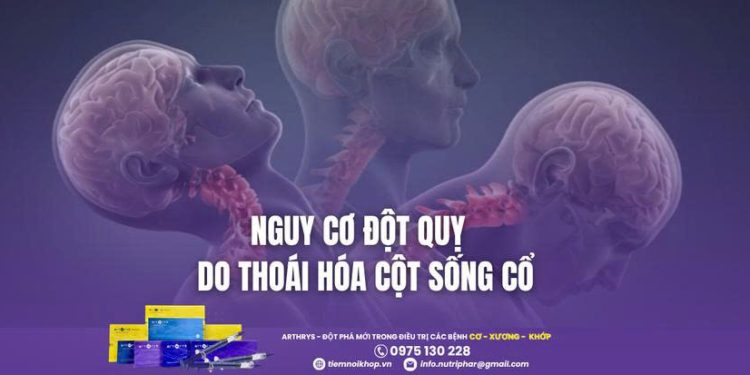 Nguy cơ đột quỵ do thoái hóa cột sống cổ