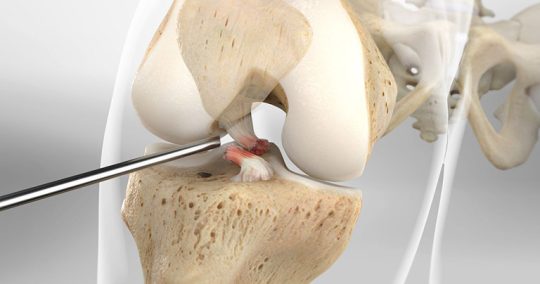 mo-dut-day-chang-cheo-5